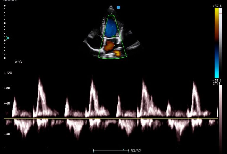 Image clinique obtenue avec TDI de l'échographe portable SIUI Apogee 1000 Lite importé par Label Médical