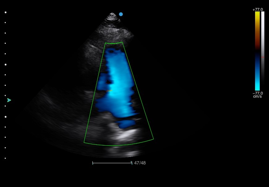 Image clinique obtenue avec l'échographe sur plateforme Doppler couleur SIUI Apogee 3300 Neo