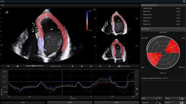 Image clinique cardiaque obtenue avec Auto SG de l'échographe Doppler Couleur sur plateforme SIUI Apogee 5500