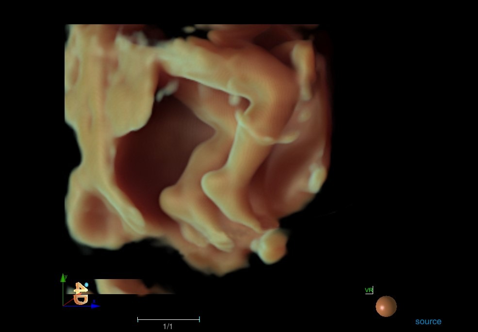 Image clinique obstétrique de fœtus 4D obtenue avec l'échographe Doppler Couleur sur plateforme SIUI Apogee 5500