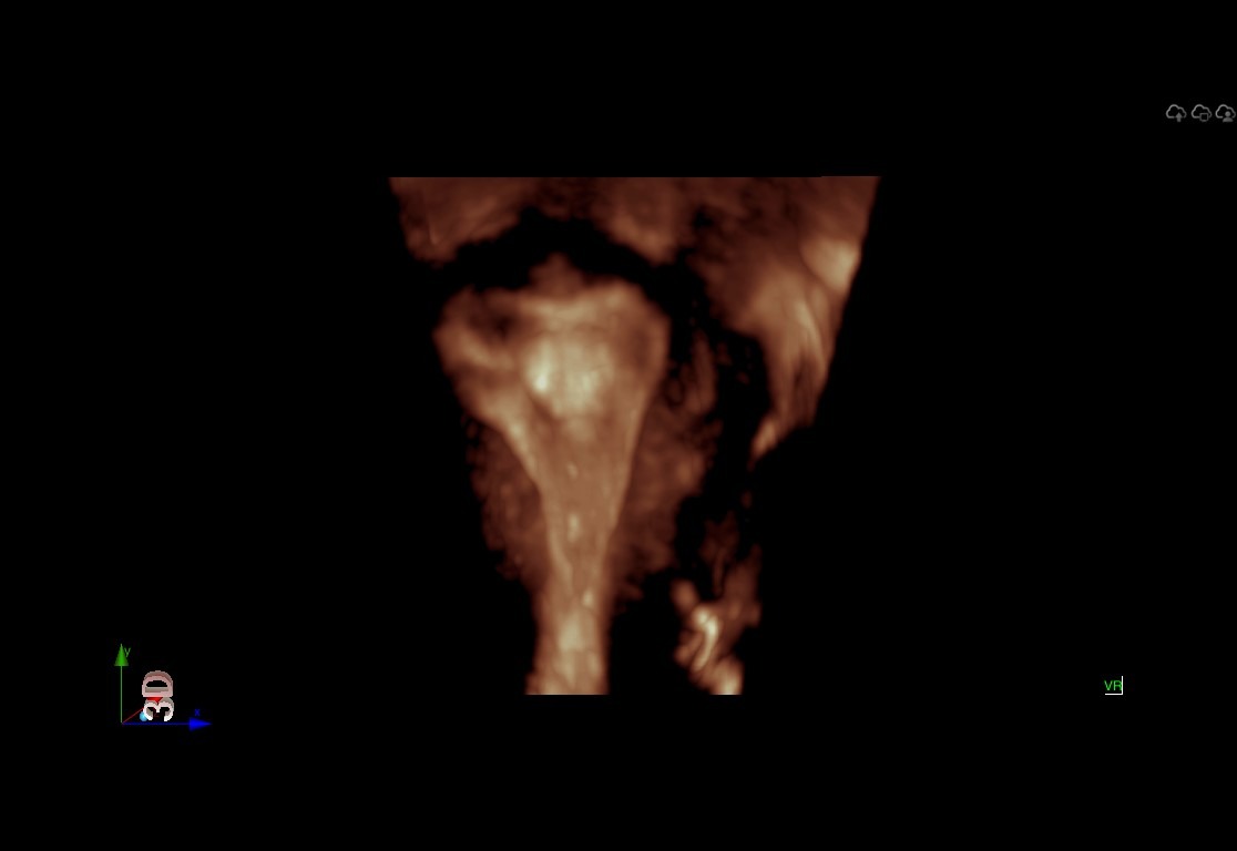 Image clinique transvaginale obtenue avec l'échographe Doppler Couleur sur plateforme SIUI Apogee 5500 importé par Label Médical