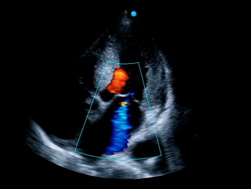 Image clinique cardiaque obtenue avec l'échographe premium Doppler Couleur sur plateforme SIUI Apogee 5800 Genius