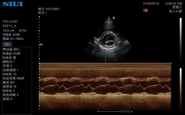 Image clinique obtenue avec l'échographe Doppler Couleur SIUI CTS 5000