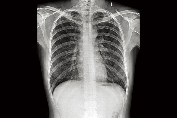 Radiographie obtenue avec le système de radiographie numérique portable SIUI SR 1000
