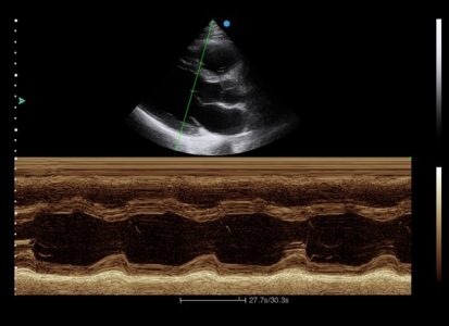 Image clinique obtenue avec le Mode M Anatomique de l'échographe sur plateforme Doppler couleur SIUI Apogee 3300 Neo