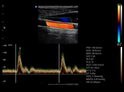 Image clinique de carotide obtenue avec l'échographe sur plateforme Doppler couleur SIUI Apogee 3300 Neo