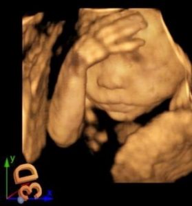 Image clinique de fœtus 4D obtenue avec l'échographe sur plateforme Doppler couleur SIUI Apogee 3300 Neo