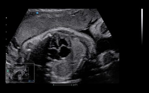 Image clinique obstétrique de cœur fœtal obtenue avec l'échographe Doppler Couleur sur plateforme SIUI Apogee 5500 importé par Label Médical