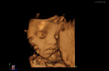 Image clinique obstétrique de fœtus 4D obtenue avec l'échographe Doppler Couleur sur plateforme SIUI Apogee 5500