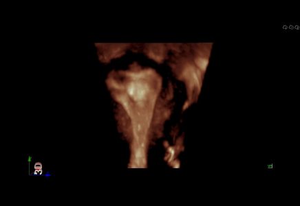 Image clinique transvaginale obtenue avec l'échographe Doppler Couleur sur plateforme SIUI Apogee 5500 importé par Label Médical