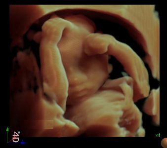 Image clinique obstétrique de fœtus 4D obtenue avec l'échographe premium Doppler Couleur sur plateforme SIUI Apogee 5800 Genius