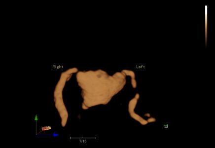 Image clinique angiographie obtenue avec l'échographe premium Doppler Couleur sur plateforme SIUI Apogee 5800 Genius