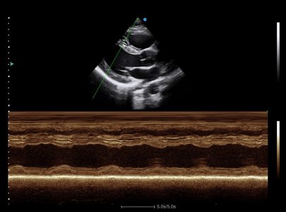 Image clinique obtenue par le mode M Anatomique de l'échographe Doppler Couleur sur plateforme SIUI Apogee 5800 Genius importé par Label Médical