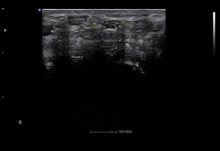 Image clinique de nerf périphérique obtenue avec l'échographe Doppler Couleur sur plateforme SIUI Apogee 5800 Genius importé par Label Médical