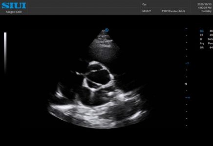 Image clinique cardiaque obtenue avec l'échographe Doppler Couleur sur plateforme SIUI Apogee 6300 importé par Label Médical