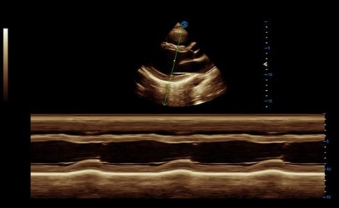 Image clinique obtenue avec le mode M Anatomique de l'échographe Doppler Couleur sur plateforme SIUI Apogee 6300 importé par Label Médical