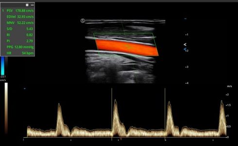 Image clinique de la carotide obtenue avec le Doppler Pulsé PW de l'échographe Doppler Couleur sur plateforme SIUI Apogee 6500 importé par Label Médical