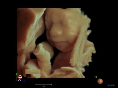 Image clinique obstétrique de fœtus en 4D obtenue par l'échographe Doppler Couleur sur plateforme SIUI Apogee 6500 importé par Label Médical