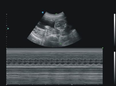 Image clinique obtenue avec le mode M de l'échographe sur plateforme SIUI CTS 4000 importé par Label Médical