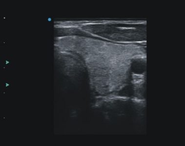 Image clinique de thyroïde obtenue avec l'échographe sur plateforme SIUI CTS 4000 importé par Label Médical